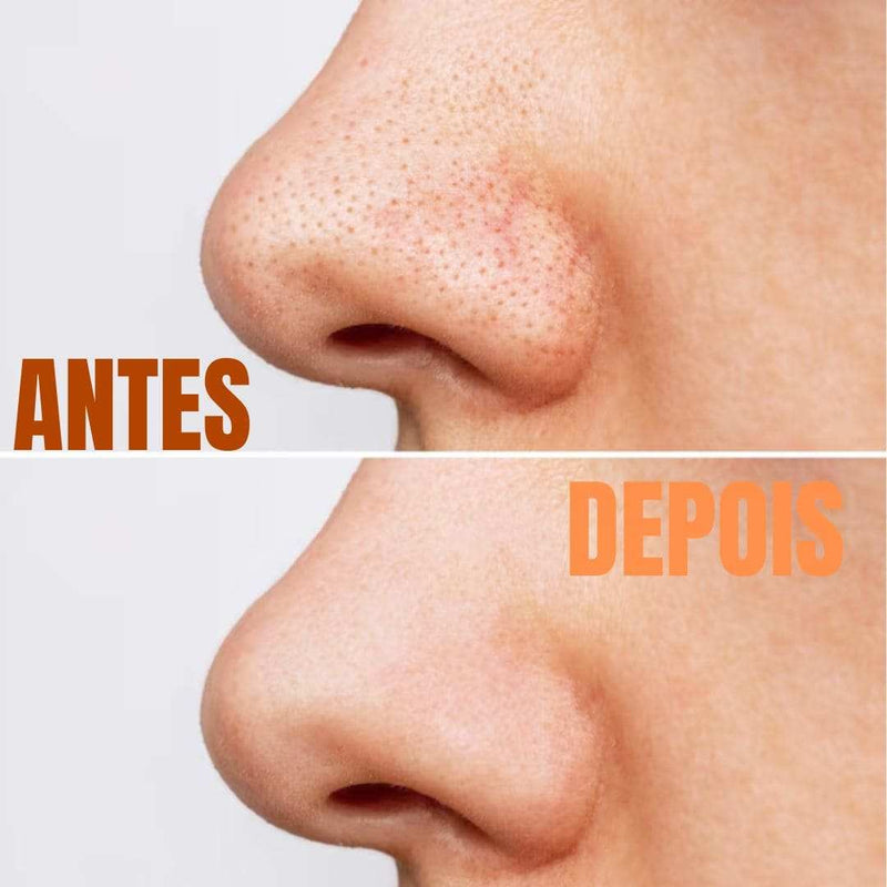 UltraLimpa Pro Antiacne + Brinde